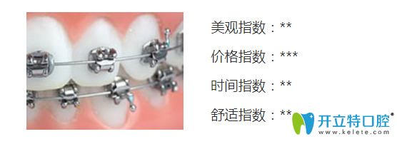 自锁金属托槽矫正 自锁金属托槽矫正