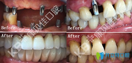 康贝佳院长李振芳多颗牙缺失CT亲骨种植技术修复+单颗牙缺失即刻种植案例