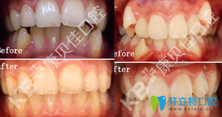 康贝佳口腔周佩佩青少年牙齿排列不齐矫正术前术后对比案例