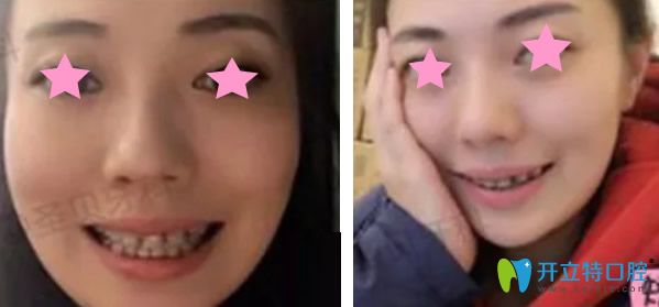 陶瓷半透明隐形矫正带牙套 陶瓷半透明隐形矫正带牙套