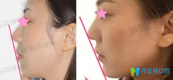成都圣贝齿科矫正牙齿一年后效果 成都圣贝齿科矫正牙齿一年后效果