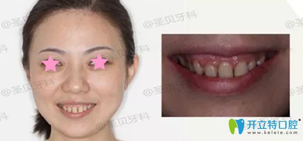 成都圣贝齿科露龈笑矫正前 成都圣贝齿科露龈笑矫正前