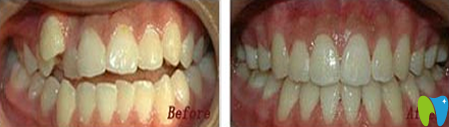 北京嘉和口腔牙齿矫正前后效果对比图