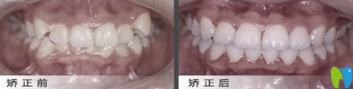 在北京佳美口腔做牙弓形态异常矫正案例治疗效果对比
