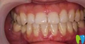 宁波口腔隐形矫正地包天牙齿18个月的恢复效果