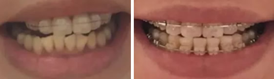 惠州爱国口腔整牙多少钱 我做陶瓷半隐形牙齿矫正花了2.1万