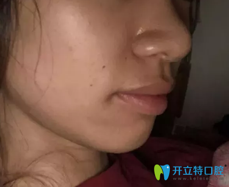 在深圳弘和口腔做牙齿正畸第400天效果图展示 在深圳弘和口腔做牙齿正畸第400天效果图展示