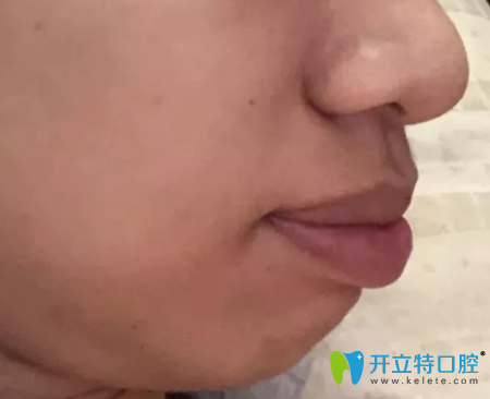 弘和口腔龅牙齿矫正第400天变化图 弘和口腔龅牙齿矫正第400天变化图