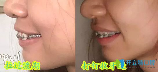 深圳弘和口腔龅牙齿矫正过渡期 深圳弘和口腔龅牙齿矫正过渡期