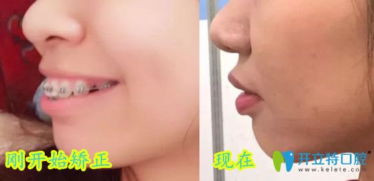 深圳弘和口腔龅牙前突矫正后对比照 深圳弘和口腔龅牙前突矫正后对比照