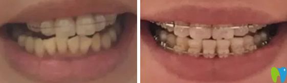 惠州爱国口腔陶瓷半隐形矫正牙齿效果对比图