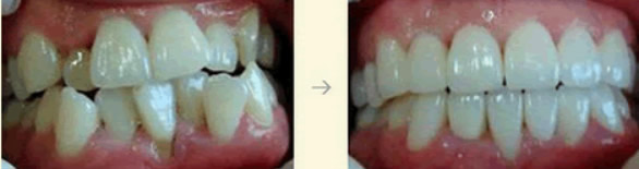 杭州牙科医院牙齿拥挤引起牙周炎牙疼怎么办 来看杭州牙科矫正案例