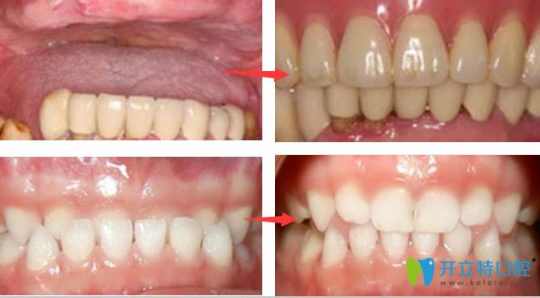 半口牙缺失种植牙+乳牙反颌正畸效果案例