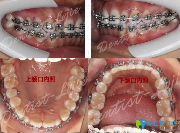 在上海圣贝做完直丝弓牙齿矫正8个月后的正畸效果