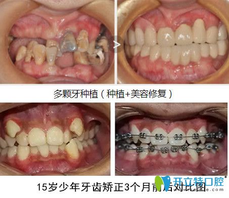 牙齿种植+青少年牙齿正畸案例前后对比照