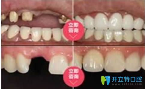 深圳宝联齿科种植牙案例图