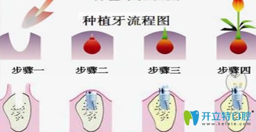 深圳宝联口腔种植牙流程图