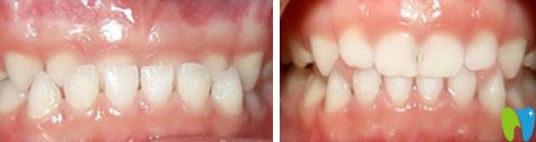 上海美奥矫正牙齿前后效果对比图