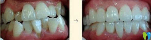 杭州牙科矫正牙齿前后效果对比图