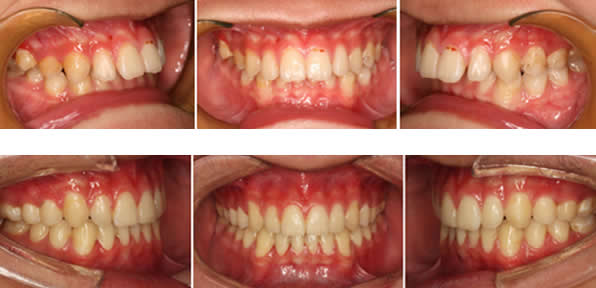在上海拜博口腔矫正牙齿2年了 现分享正畸前后效果对比图片
