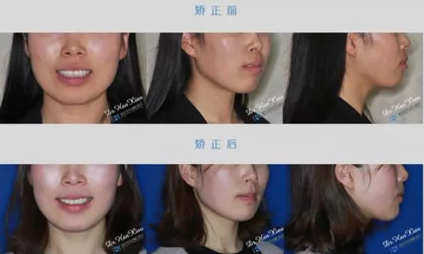 上海科瓦齿科看26岁的小姜在上海科瓦齿科牙齿矫正案例 效果堪比整形哦