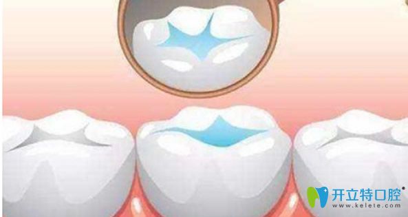 蛀牙早期可以通过补牙来修复