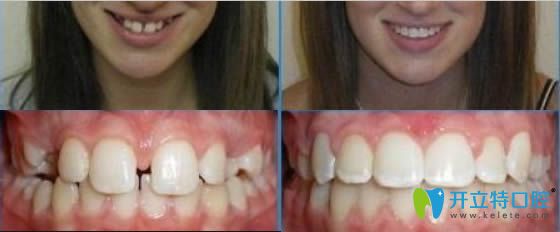 深圳宝联齿科牙齿矫正效果对比图