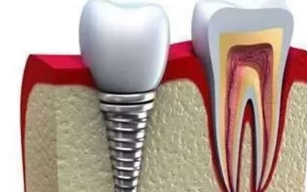 牙齿缺失怎么修复 活动义齿固定义齿+种植牙三种方法哪个好