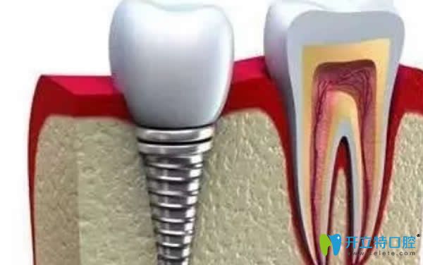 种植牙不需磨牙不会引起牙体组织损伤