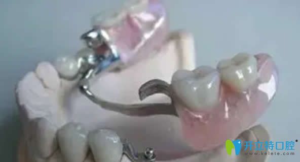 活动义齿是牙缺失的一种修复方式