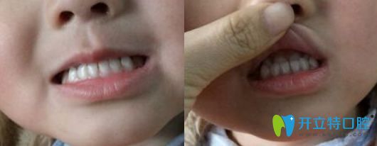 3岁女儿去西安雁塔惟真口腔做牙齿矫正前的图片