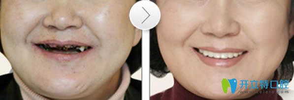 北京美年口腔刘海波院长老年人牙齿缺失种植牙前后对比效果