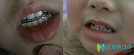 惟真口腔3岁女儿矫正牙齿第7天