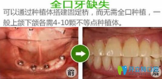 深圳宝联齿科种植牙效果对比图