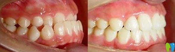 科尔口腔隐适美牙齿矫正前后效果