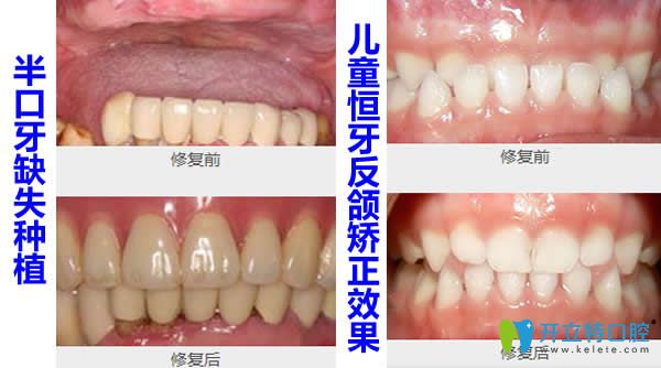 松丰口腔半口牙缺失种植+牙齿反颌正畸效果案例
