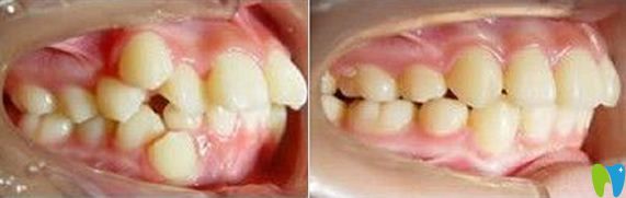 科尔口腔牙齿矫正前后效果 科尔口腔牙齿矫正前后效果