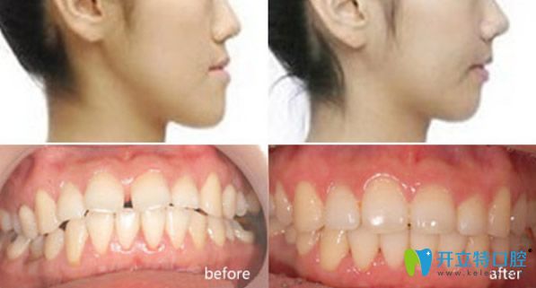 牙齿稀疏、前突矫正前后效果对比图