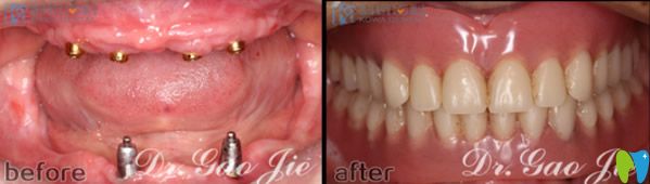 <!--<i data=20240703-sp></i>-->科瓦齿科种植牙效果