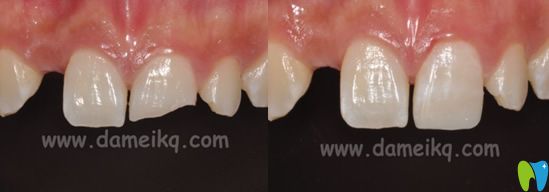 大美口腔程浩树脂直接修复外伤前牙治疗前后对比图