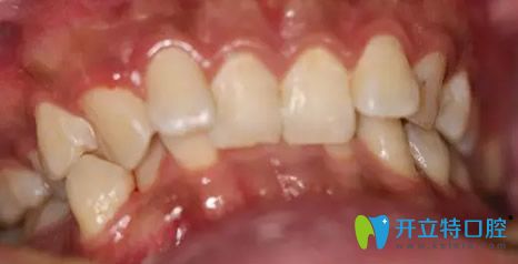 优贝口腔牙齿矫正前