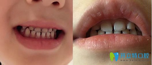 5岁儿子在西安欢乐口腔做牙齿地包天矫正前后对比图