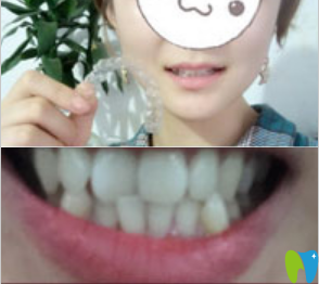 上海永华口腔看牙怎么样?分享我做隐适美牙齿矫正的实记