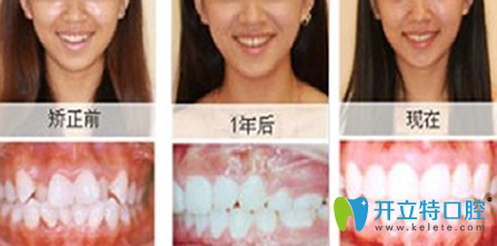 西安时代口腔刘育鑫牙齿矫正前后效果对比图
