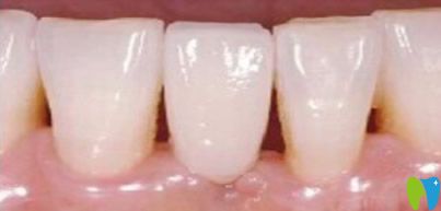 优贝口腔宋铁砾种植牙齿效果代表案例