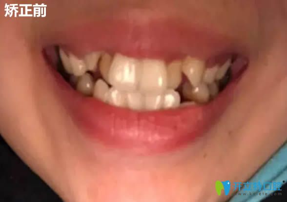 来看我在上海维佳康口腔做的金属托槽牙齿矫正效果怎么样