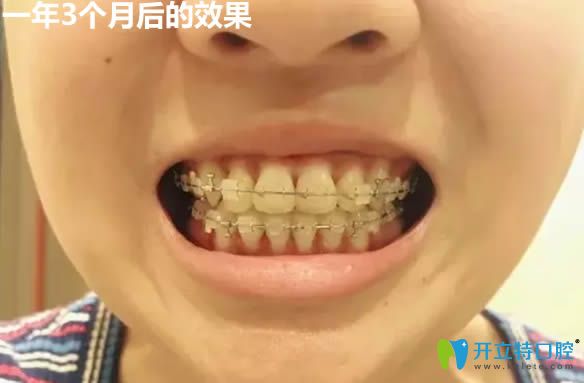 做完金属托槽牙齿矫正一年三个月效果
