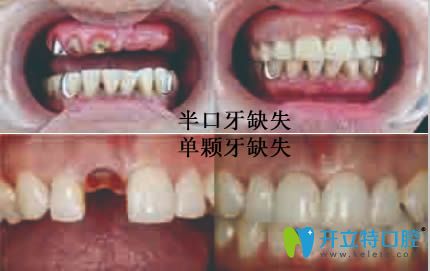 重庆贝尔口腔种植牙效果对比图