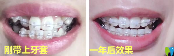 北京五月花口腔矫正牙齿效果案例