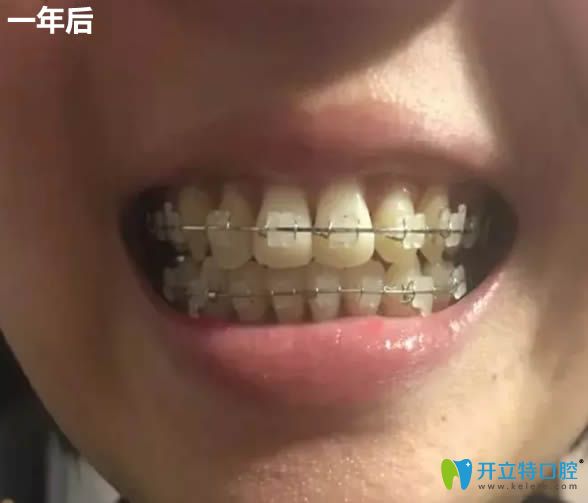 在上海维佳康做完牙齿矫正一年后牙齿情况